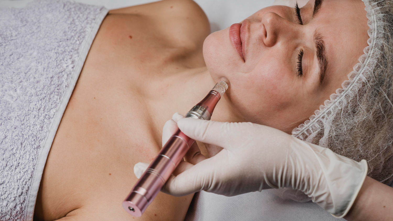 Microneedling Treatment