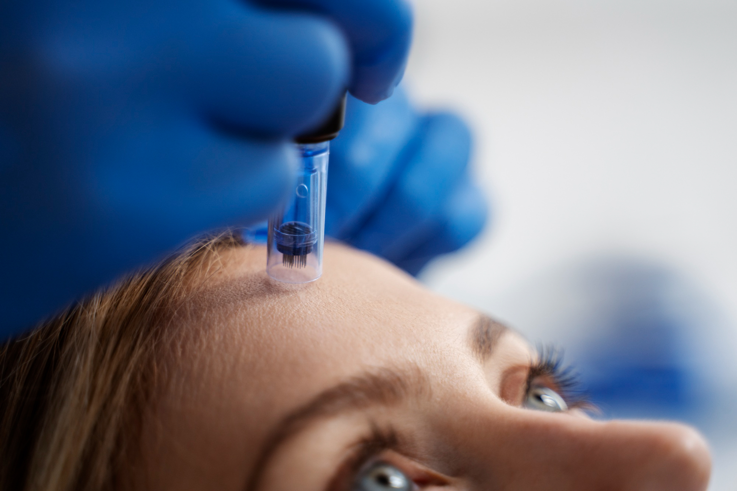 PRP Microneedling